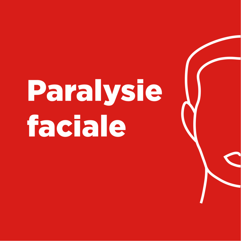 Paralysie faciale
