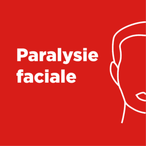 illustration paralysie faciale